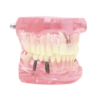Dantų Dantų Modelio Mokyti Studijų Žodžiu Implantų Atkurti & Patologija M2001 Rožinė